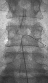 신경성형술 이미지 2