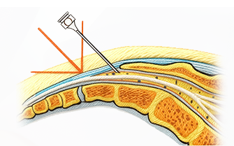 신경성형술 추가 이미지
