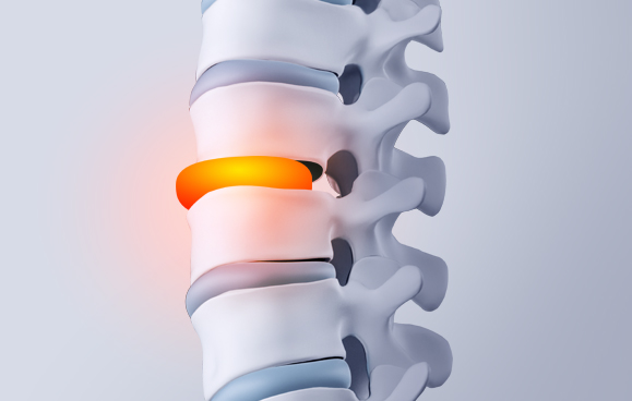 목디스크 관련 이미지 4